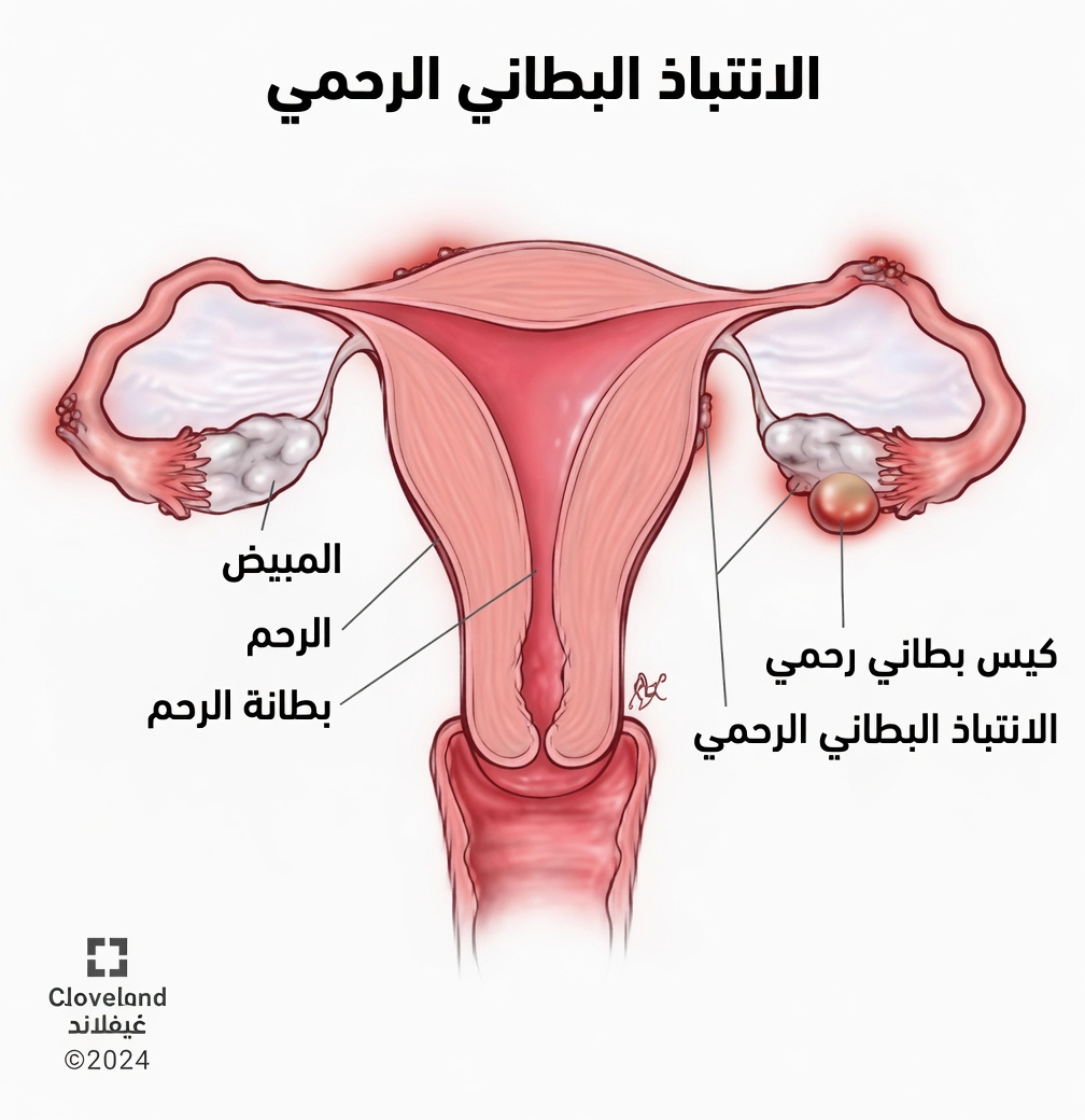 ما هو الانتباذ البطاني الرحمي ولماذا يجب على كل امرأة أن تعرف عنه؟