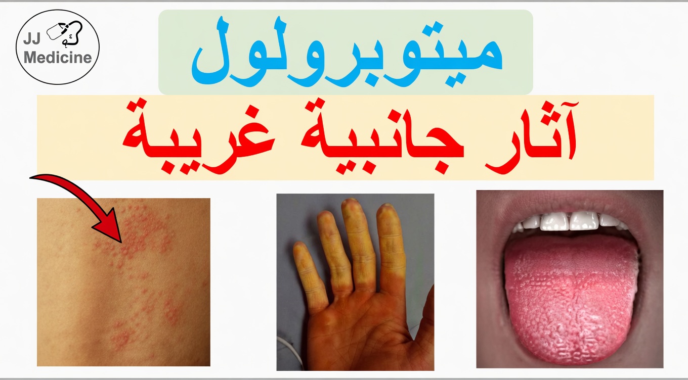 ما هي الآثار الجانبية العشرة الشائعة للميتوبرولول وكيف يمكنك ملاحظتها مبكرًا؟