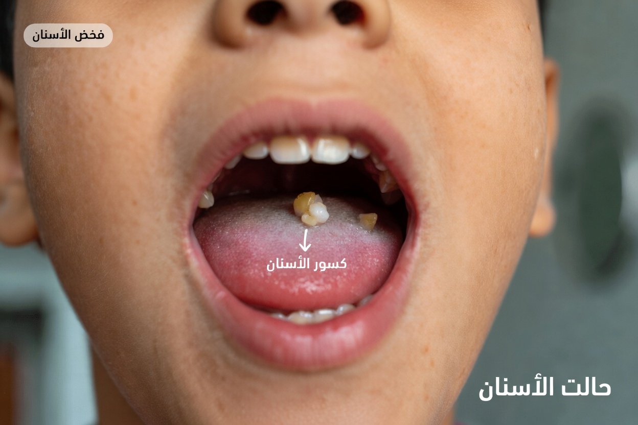 لماذا تستمر رائحة الفم الكريهة حتى بعد تنظيف الأسنان بالفرشاة؟ هل يمكن أن تكون حصى اللوزتين السبب الخفي؟