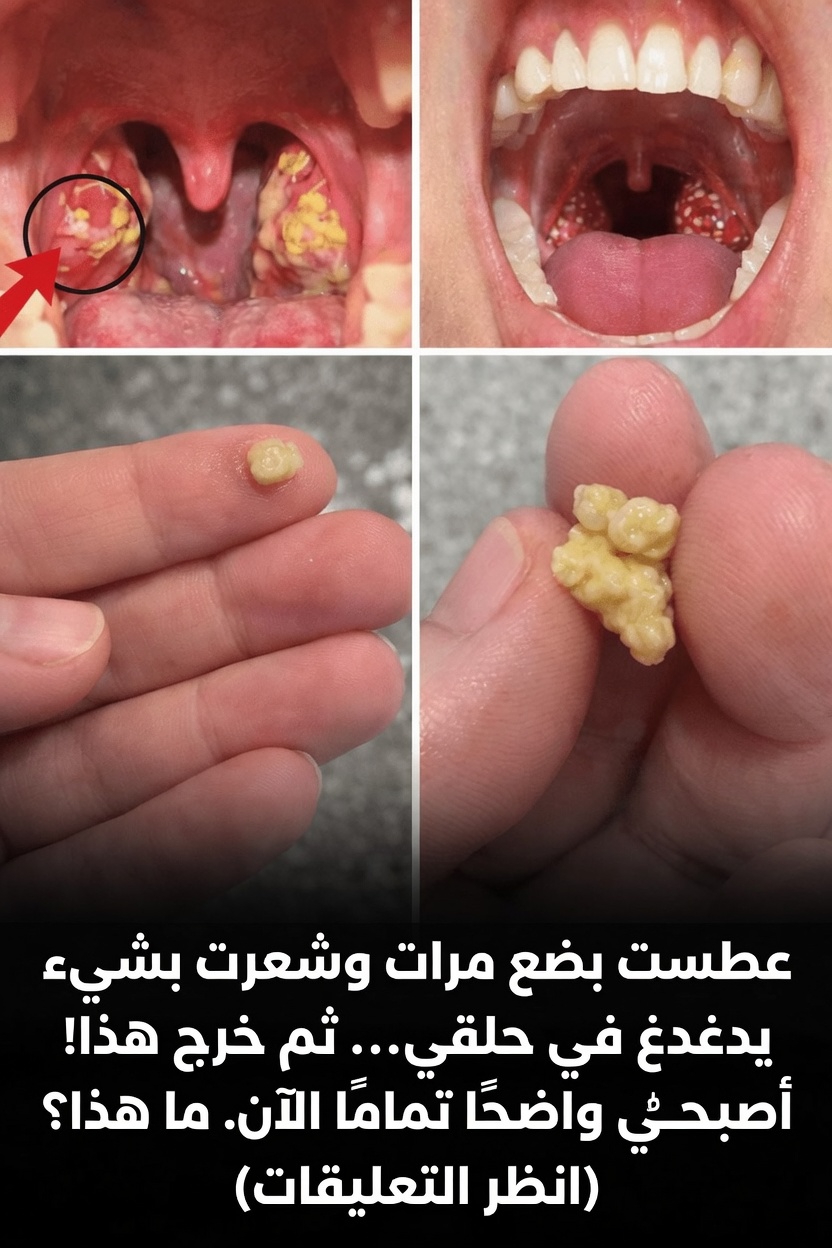 ما تلك الكتلة الصغيرة التي خرجت من حلقك بعد العطس؟ فهم حصوات اللوزتين