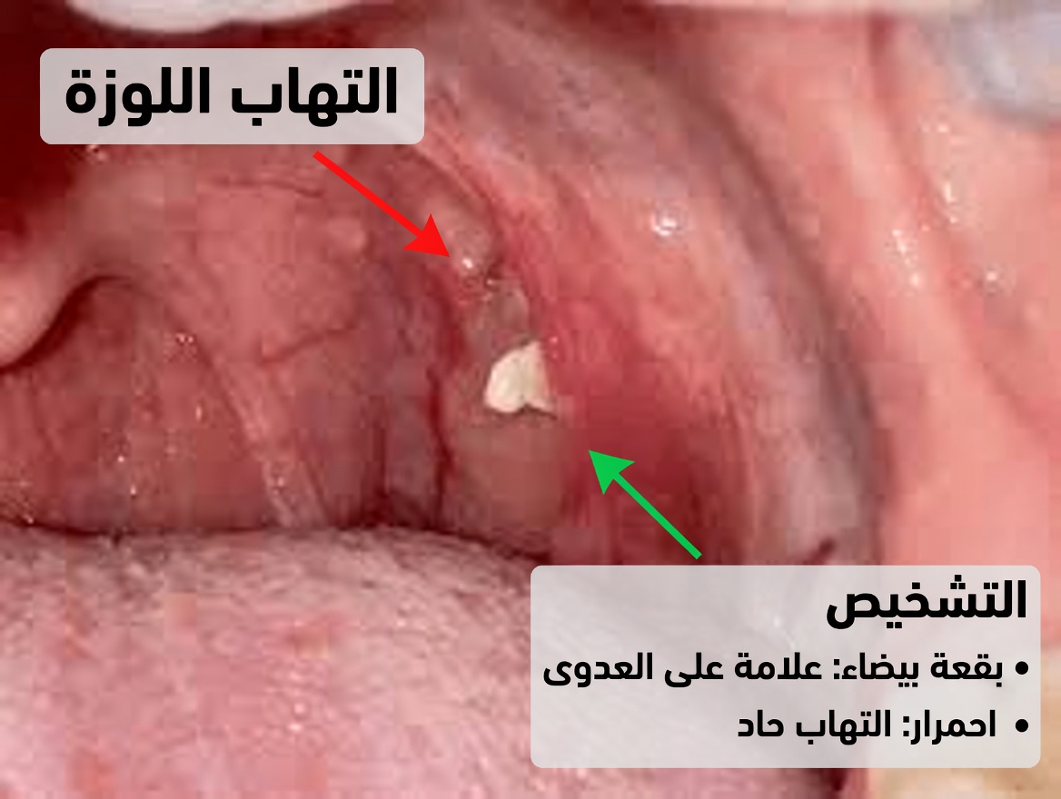 ما تلك الكتلة الصغيرة التي خرجت من حلقك بعد العطس؟ فهم حصوات اللوزتين