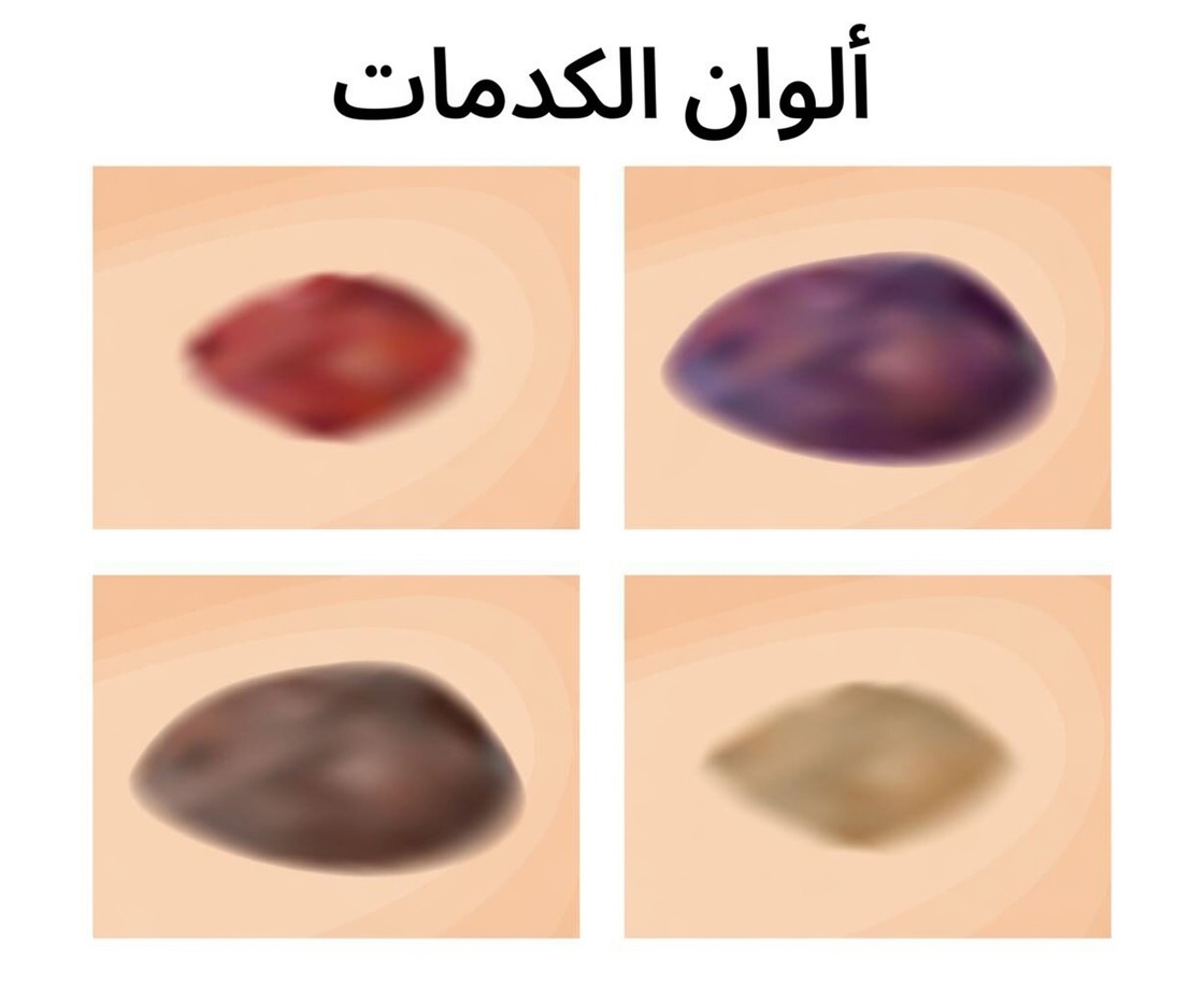 ماذا يعني لون الكدمة لديك؟ تحذير قد يكون جسمك يرسله