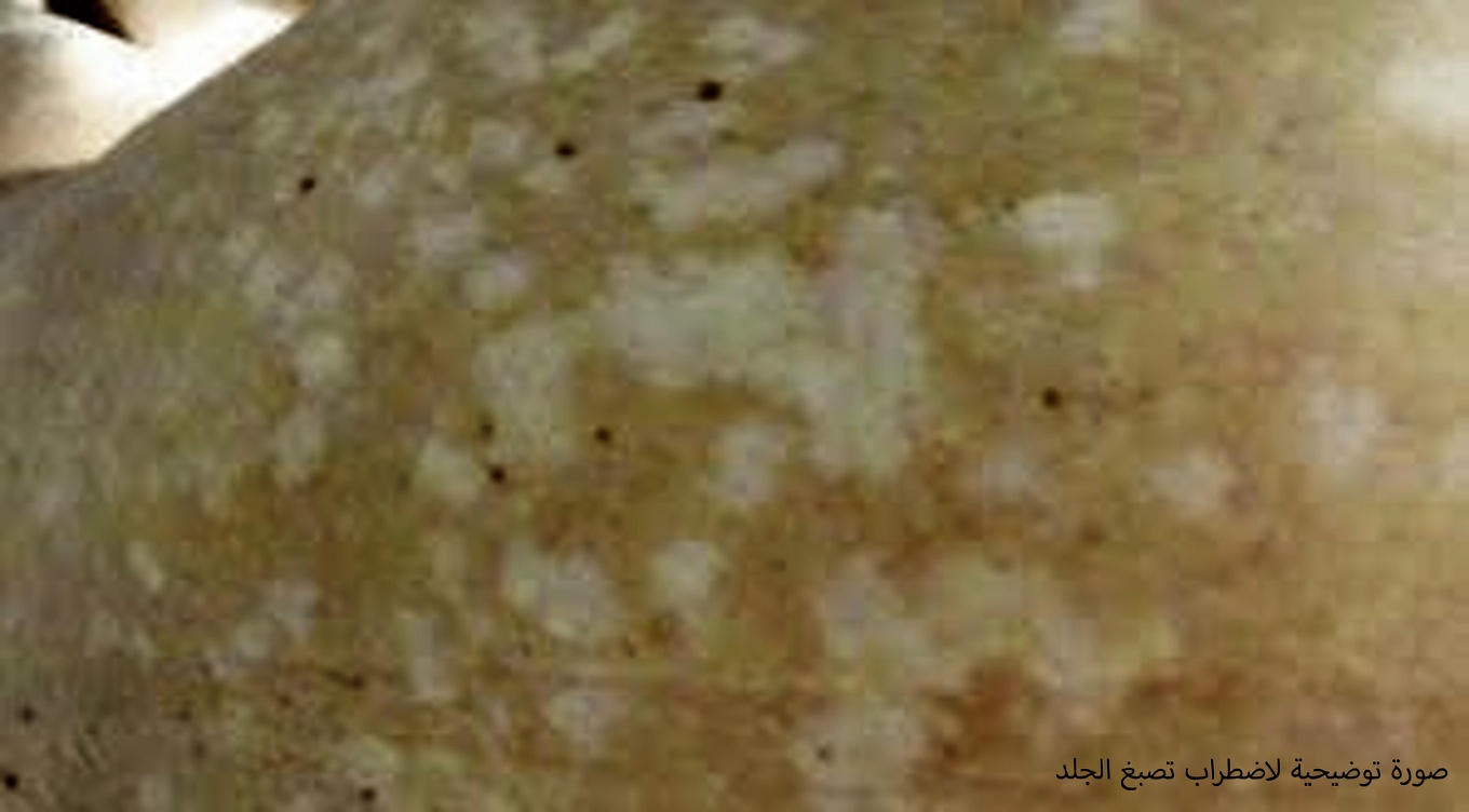 لماذا تظهر بقع بيضاء صغيرة على ذراعيك وساقيك؟ فهم التغيرات الجلدية الشائعة