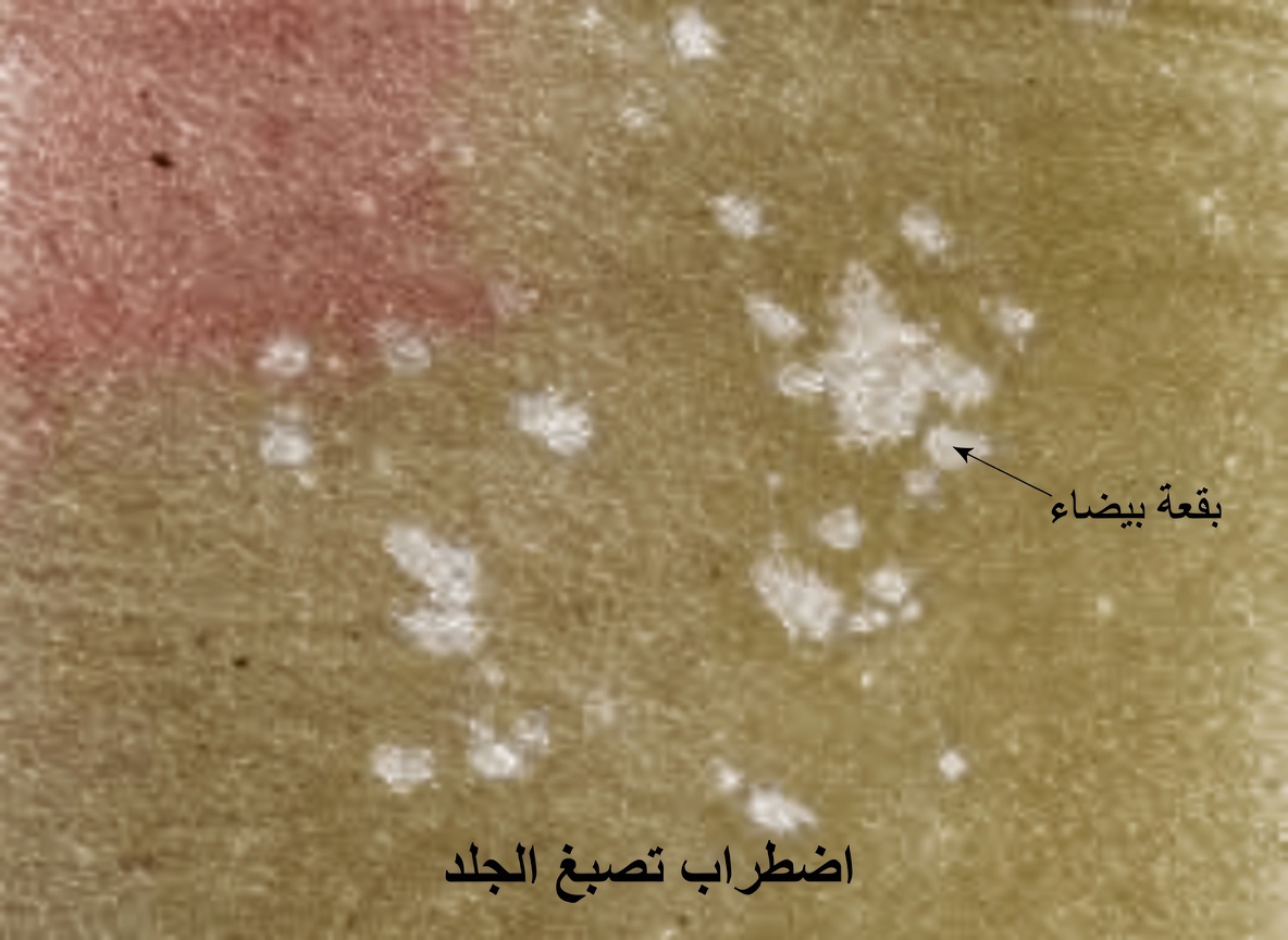 ما هذه البقع البيضاء الصغيرة على الجلد؟