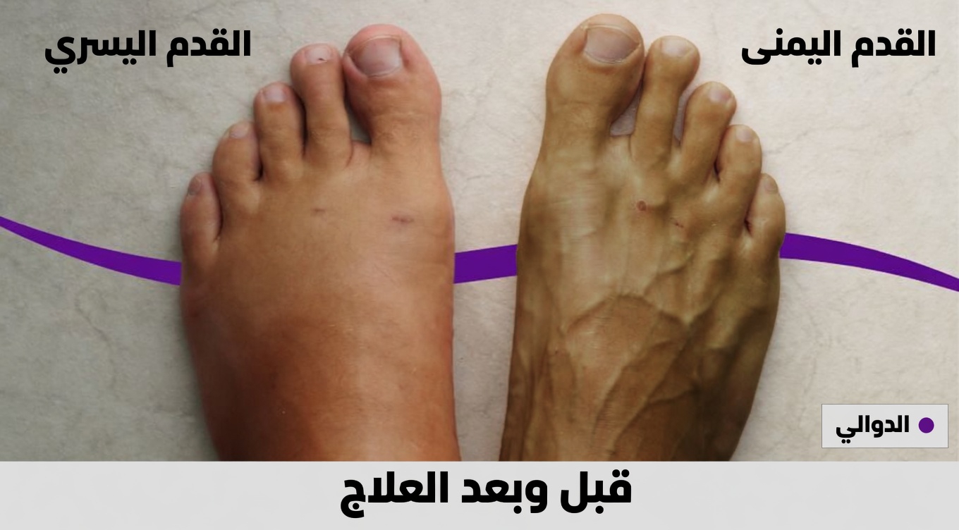 هل يمكن أن يكون ألم الساق «غير الضار» علامة تحذيرية لا ينبغي تجاهلها؟