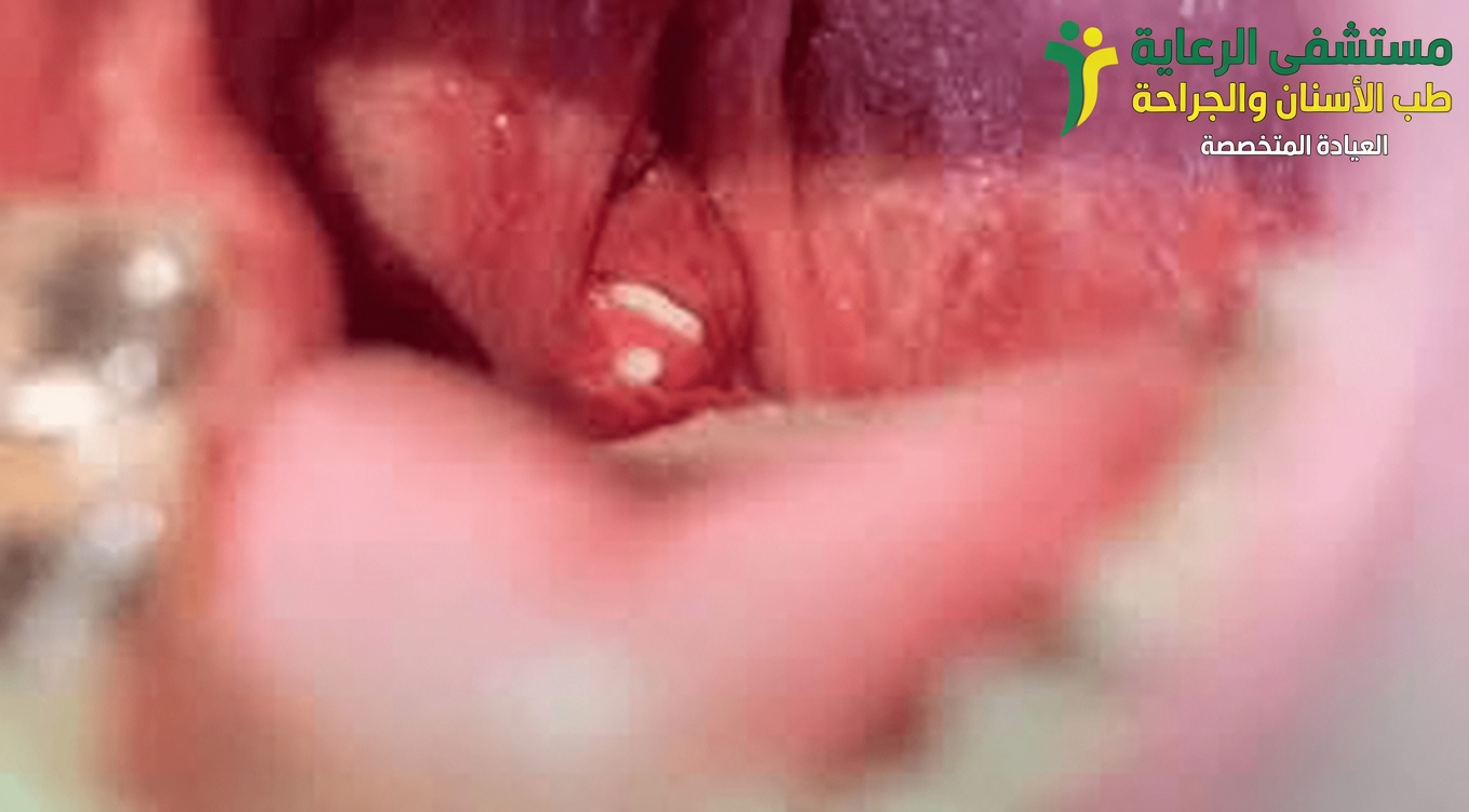 حصى اللوزتين: ما هي ولماذا قد تكون وراء رائحة الفم الكريهة المستمرة