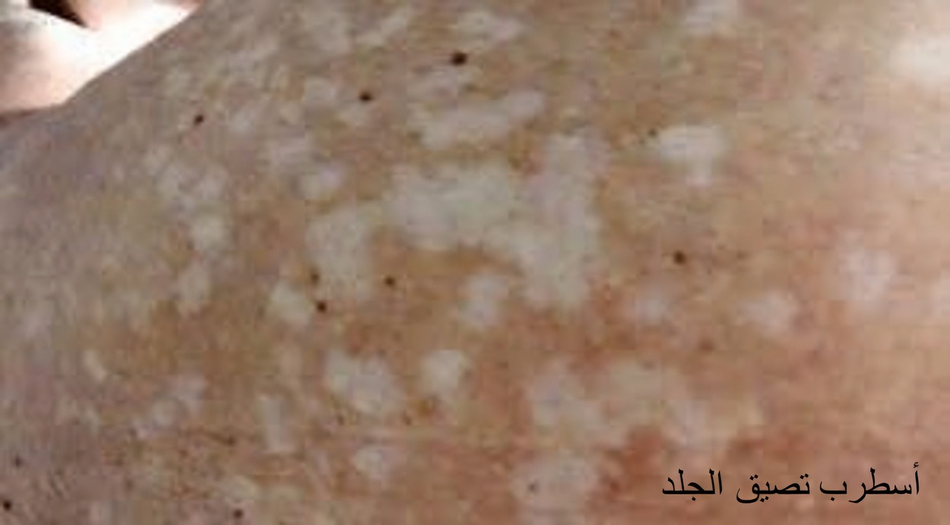 تلك البقع البيضاء الصغيرة على ذراعيك وساقيك وظهرك: ما تحتاج إلى معرفته عن هذا التغير الجلدي الشائع