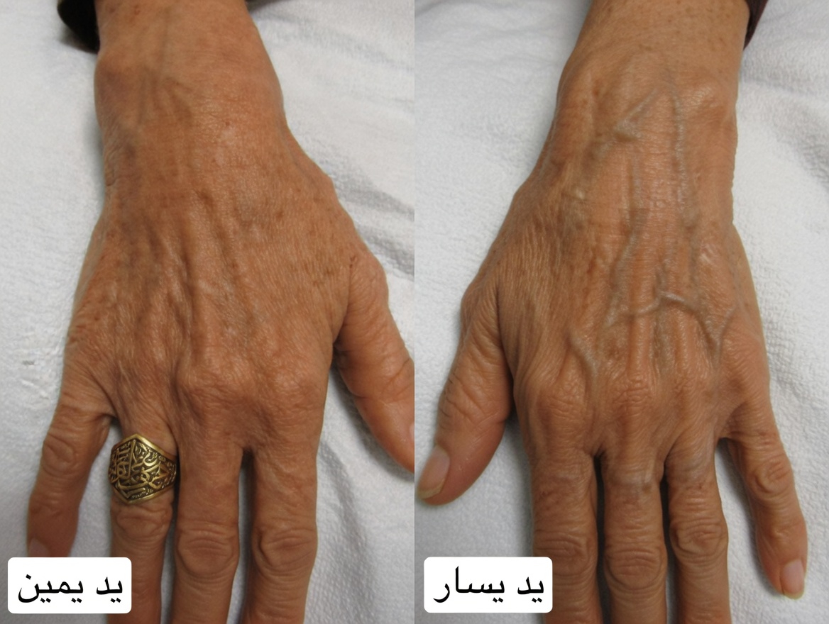 10 طرق طبيعية للتخلص من الدوالي وتعزيز تدفق الدم بشكل طبيعي