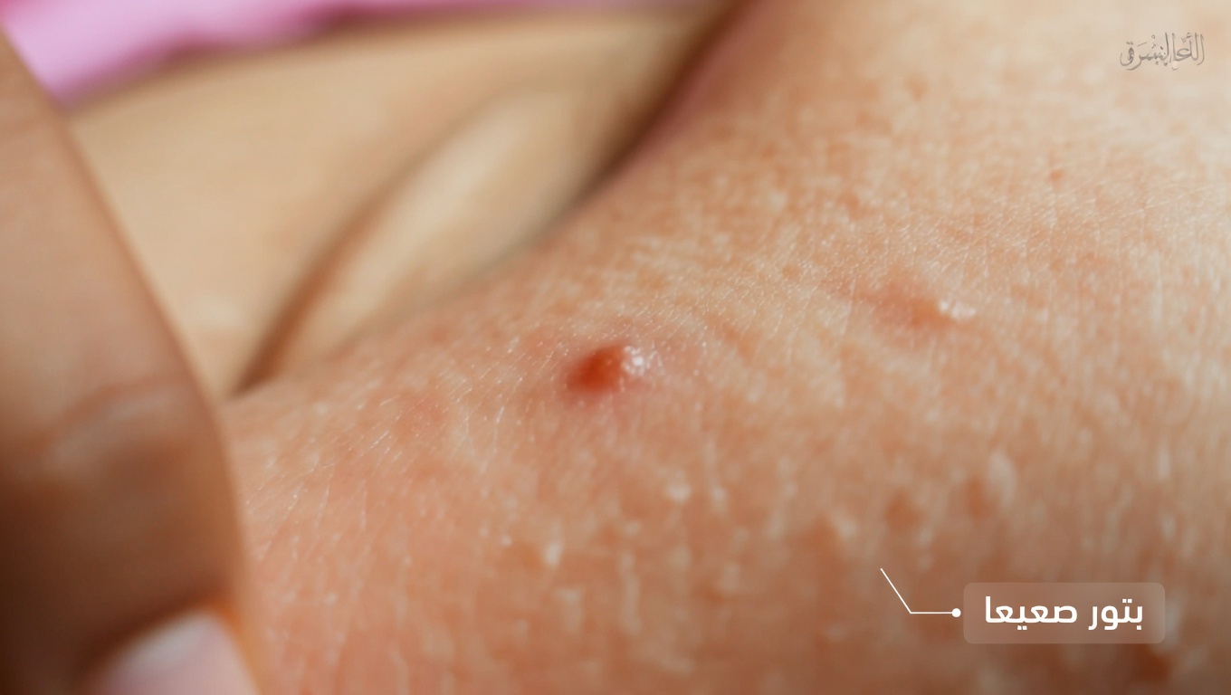 12 علامة مبكرة للسرطان يجب ألا تتجاهلها أبدًا