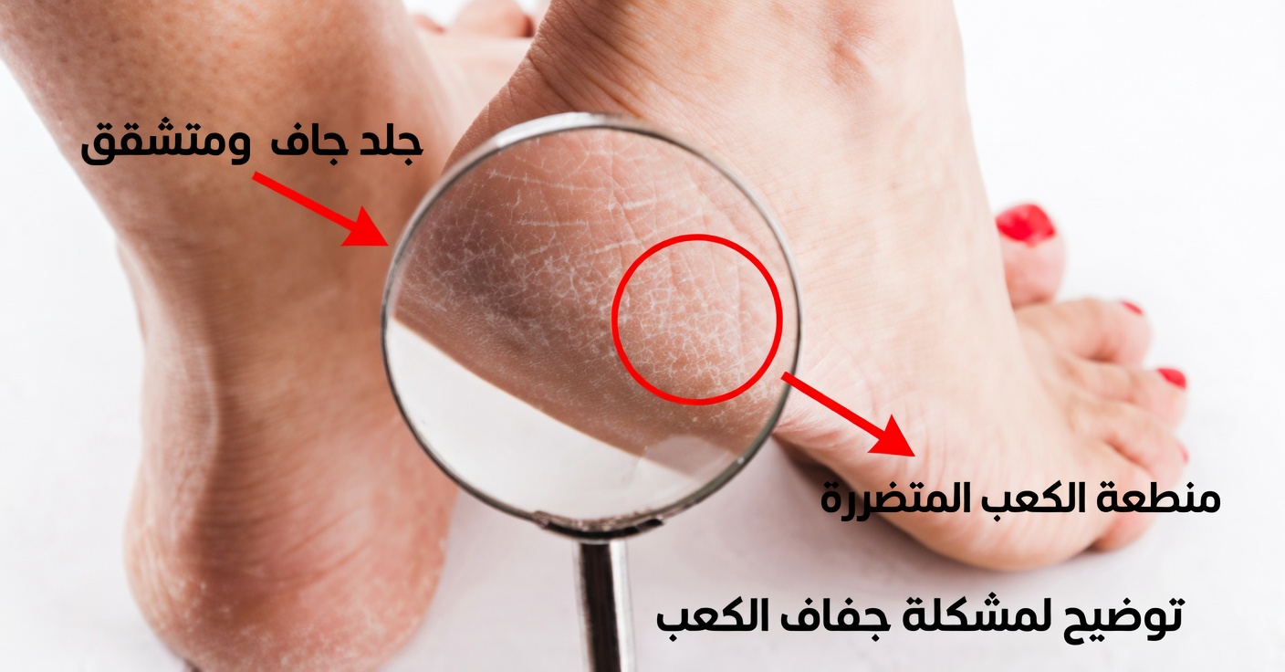 الأسبرين لمسامير القدم والتشققات في القدمين