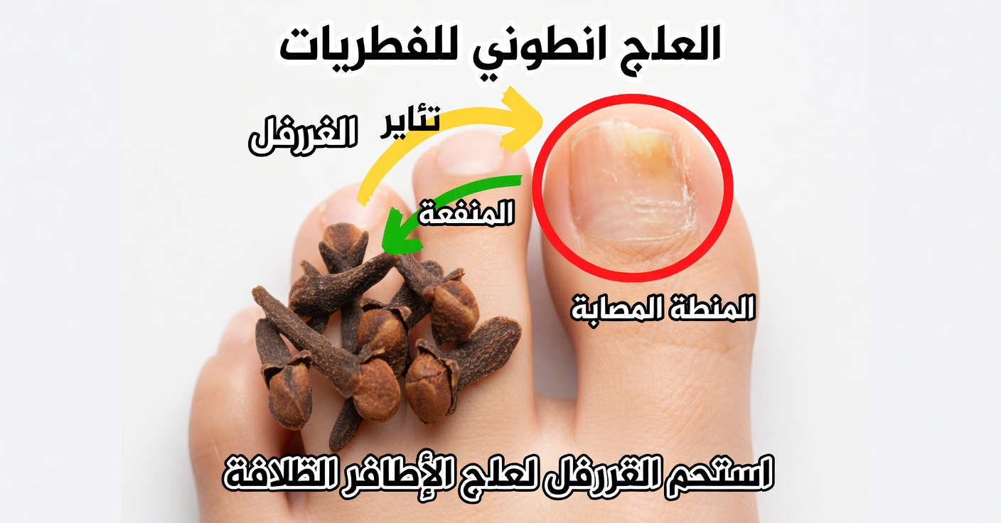كيفية التخلص من فطريات الأظافر باستخدام القرنفل