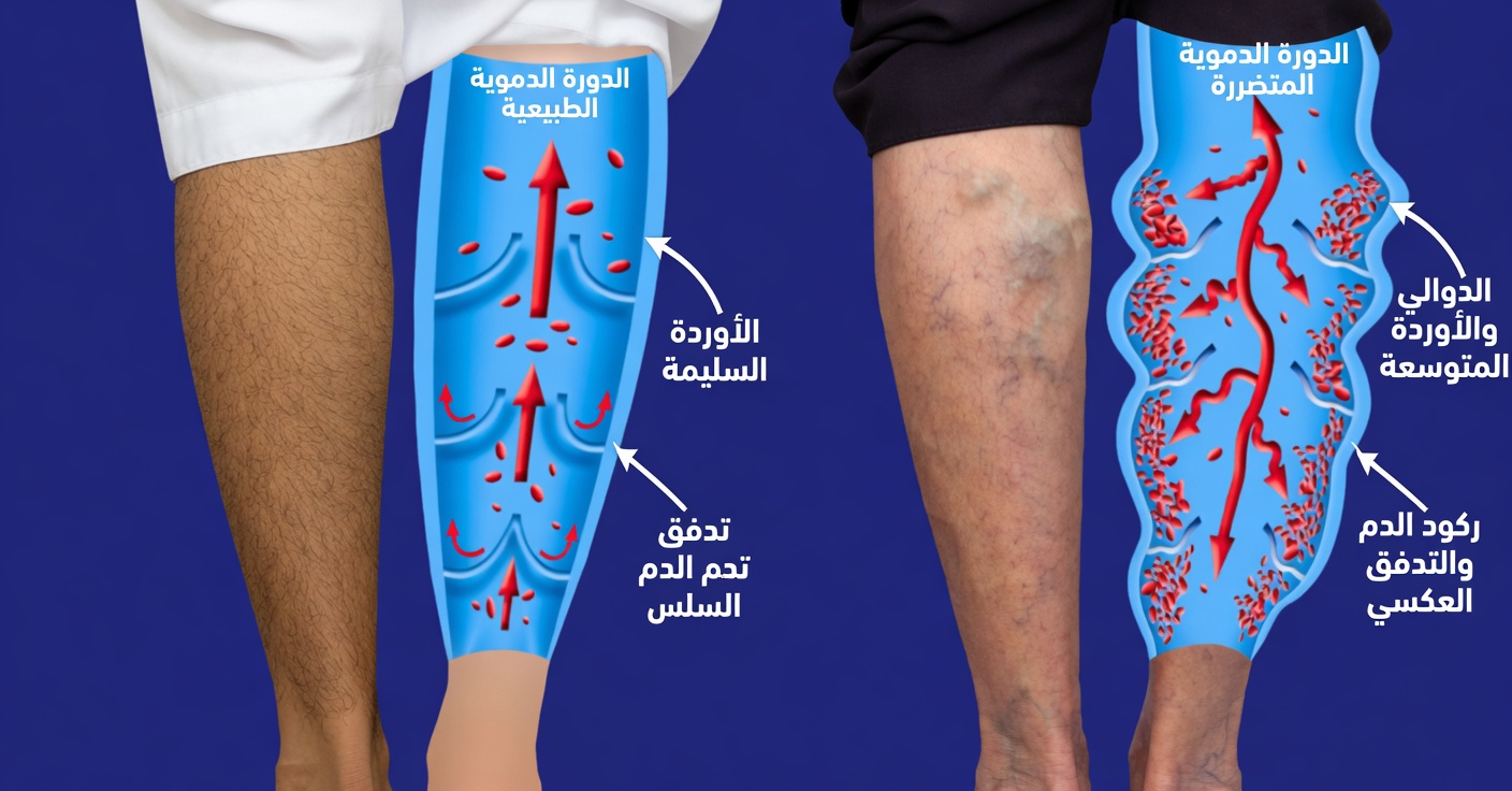 اكتشف الفوائد الطبيعية لشاي الكركديه في إنقاص الوزن