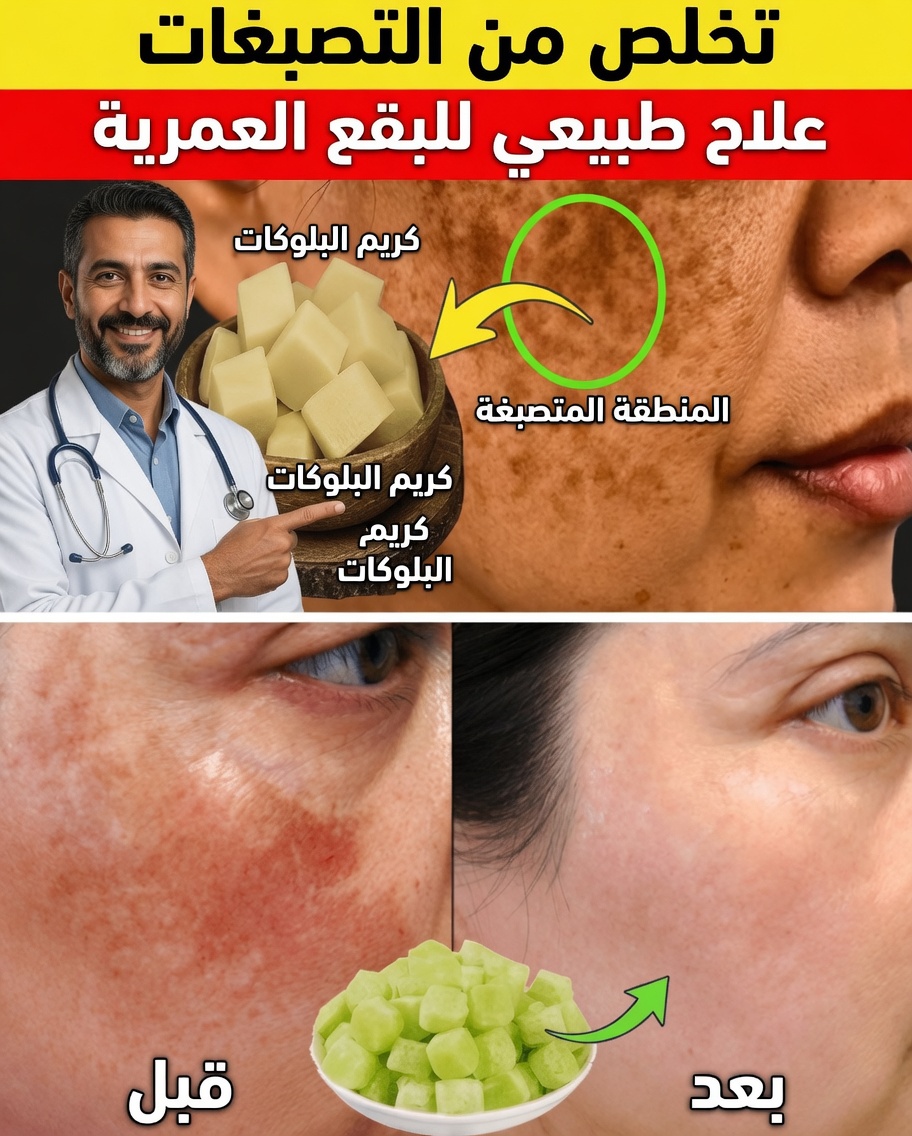 امسحي التصبغات والكلف والبقع الداكنة طبيعيًا خلال 20 يومًا – طقس لطيف لبشرة متألقة