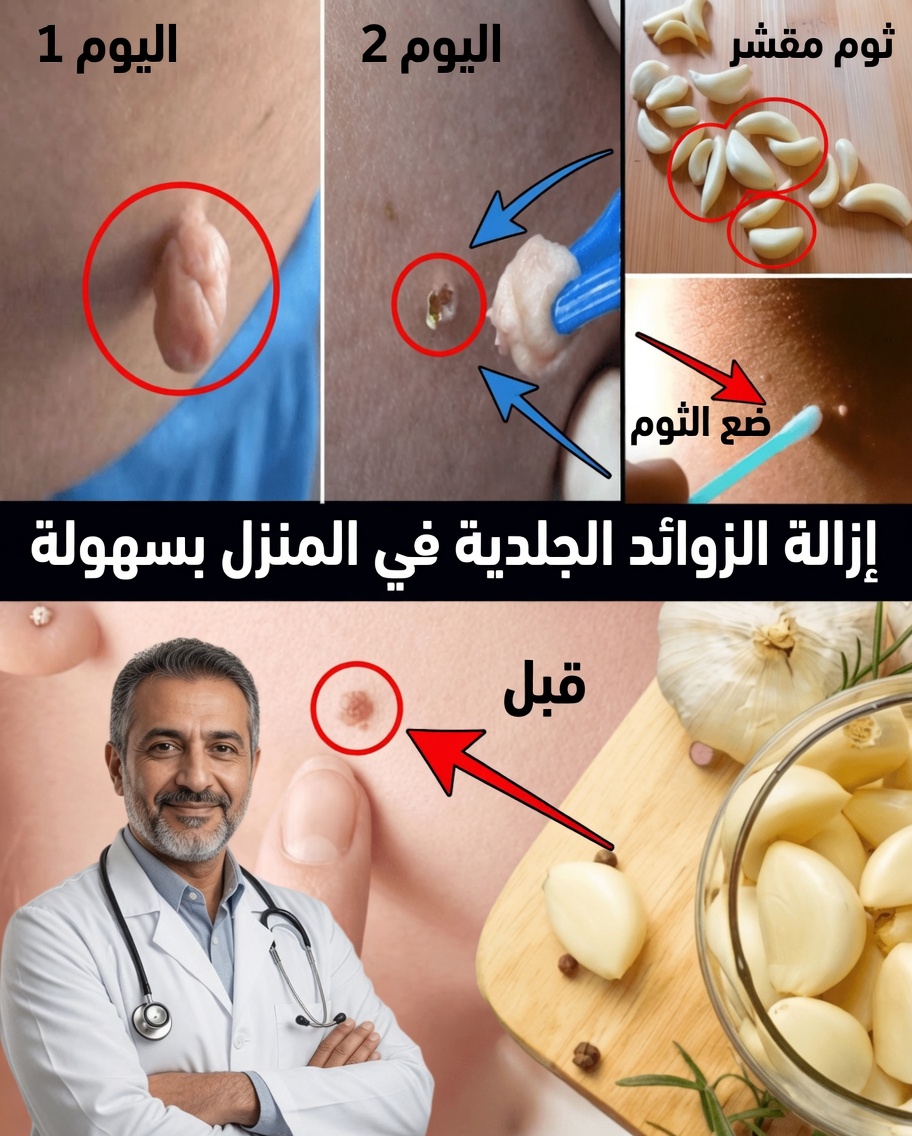 كيفية إزالة زوائد الجلد طبيعيًا بالفازلين: طريقة بسيطة خلال ليلة واحدة