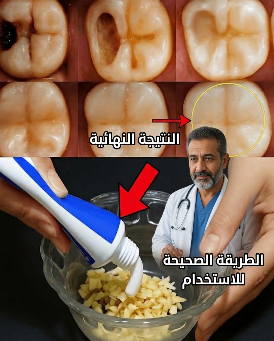 ما نادرًا ما يخبرك به أطباء الأسنان: نصائح طبيعية قد تساعد في الوقاية من تسوس الأسنان
