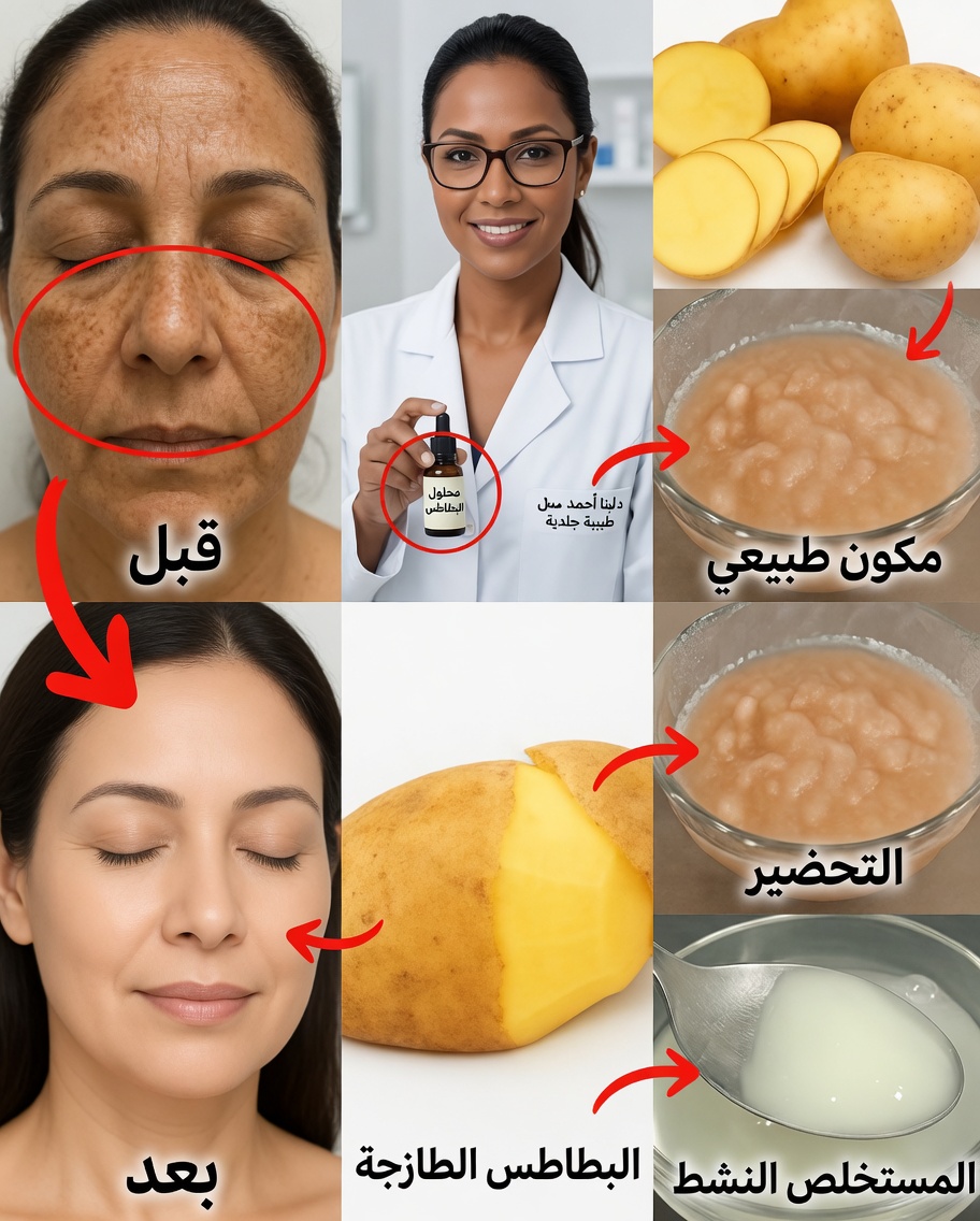 حيلة جلّ البطاطس التي يمكن أن تساعد على تفتيح البقع الداكنة طبيعيًا
