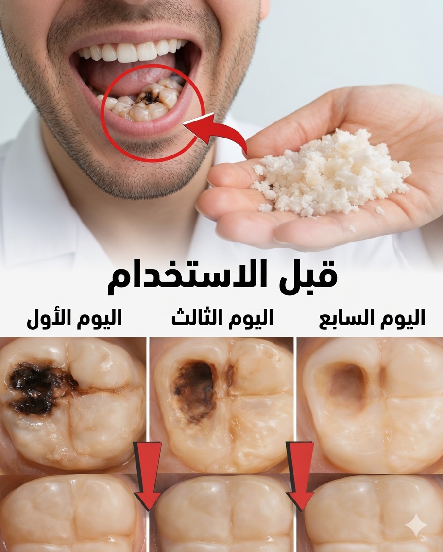 حافظ على هذه العادات لتجنب طبيب الأسنان: كيف تساعد أسنانك على إصلاح التسوس المبكر بشكل طبيعي